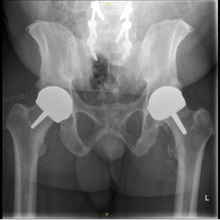 Post-operative X-ray showing bilateral hip resurfacing in a patient with previous lumbar spinal fusion, performed by Mr Shakir Hussain at the Royal Orthopaedic Hospital Birmingham